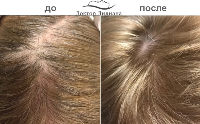 результат от процедуры Regenera 